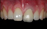 Beispiele Implantat Kronen