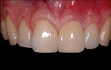 Beispiele Implantat Kronen